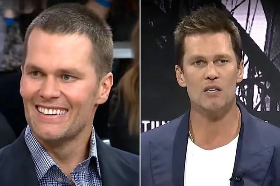 El Misterio del Cabello de Tom Brady: ¿Se Hizo un Trasplante Capilar?