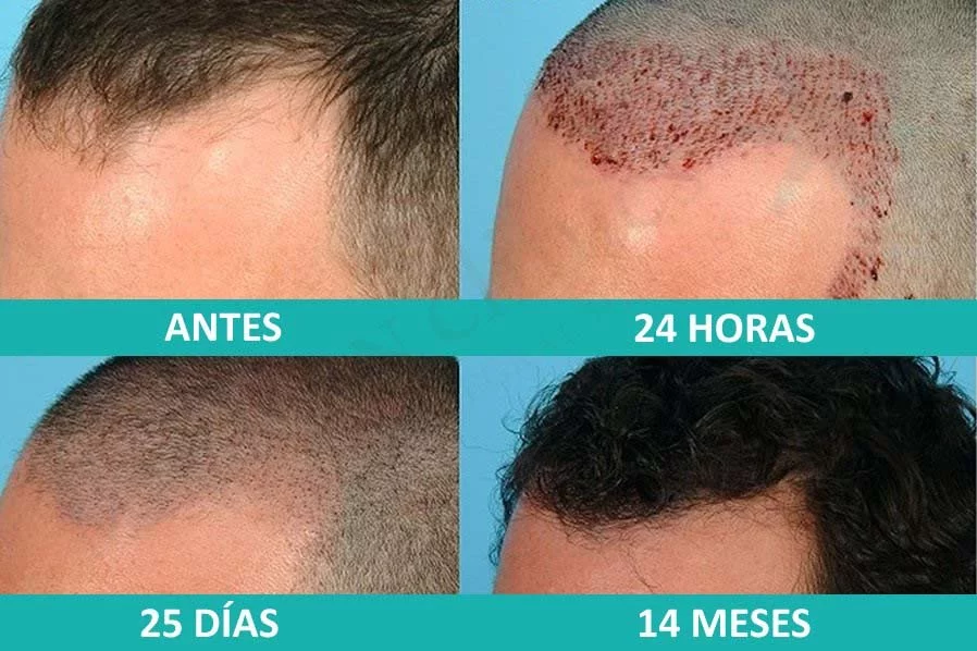 Cuidados posteriores al trasplante capilar para crecer el cabello más rápido