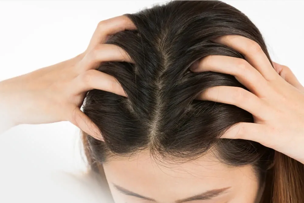 Inflamación y enrojecimiento causados por foliculitis en el cuero cabelludo.