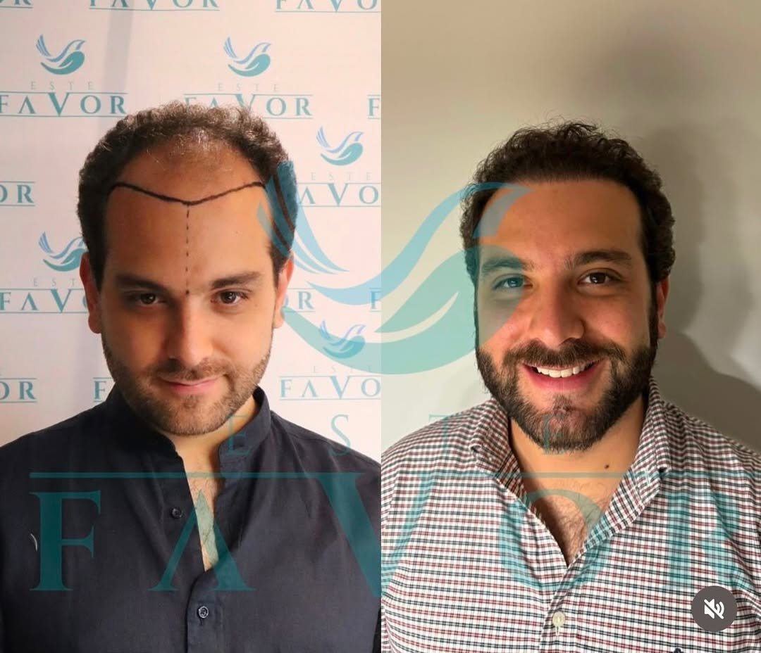 ¿Los trasplantes capilares se ven naturales?