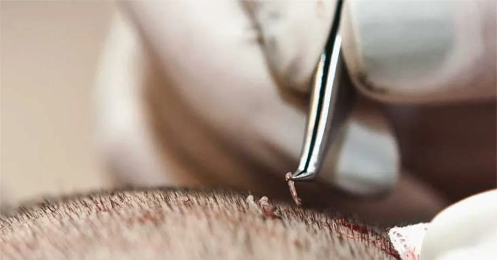 Preparación de la tira en el método FUT para injerto capilar en España.